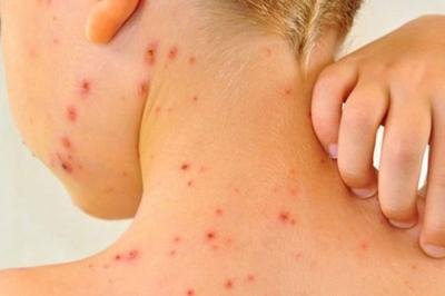 Kızamıkta ölümcül tehlike!