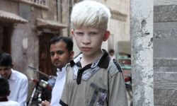 Albinizm Farkındalık Günü