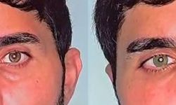 Göz rengini kalıcı olarak değiştirmek mümkün