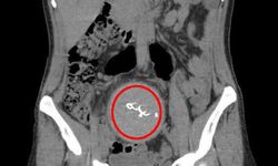 Antalya’da doğumda gazlı bez unutuldu
