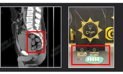 Tomografide şoke eden görüntü
