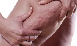 ‘Lipödem diyet ve egzersizle önlenebilir’