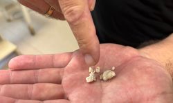 Tükürük bezinden 5 taş çıkarıldı