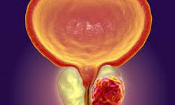 Prostat kanserine özel akıllı görüntüleme