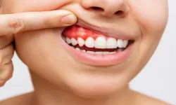 Diş eti hastalıkları hayati risk oluşturuyor