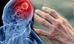 Uyku bozuklukları Parkinson'dan kaynaklanıyor olabilir