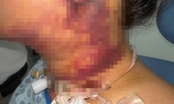 Estetik operasyon kabusa döndü: 5 milyon TL’lik dava