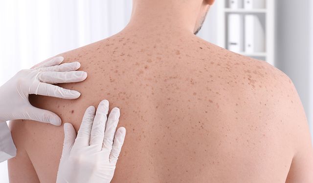 Uzmanından cilt kanserinden korunma uyarısı