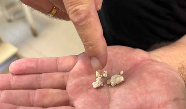 Tükürük bezinden 5 taş çıkarıldı