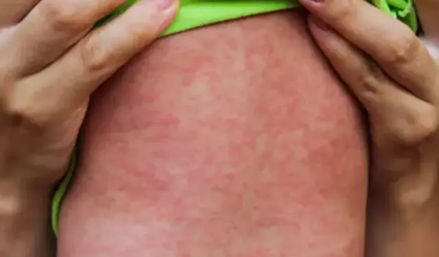 Uzmanından kızamık açıklaması