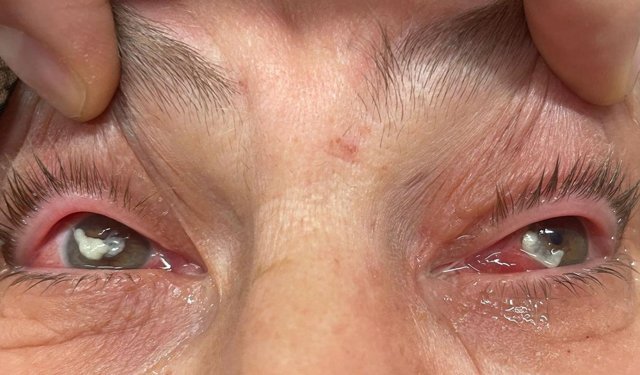 Kırlangıç otu kullanımına dikkat